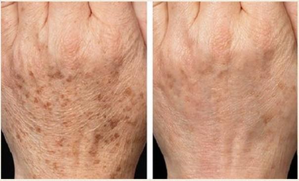 如何淡化老年斑（这三种方法最有效）