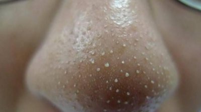 ​鼻翼两侧长粉刺，鼻子两侧长粉刺要怎么去除？