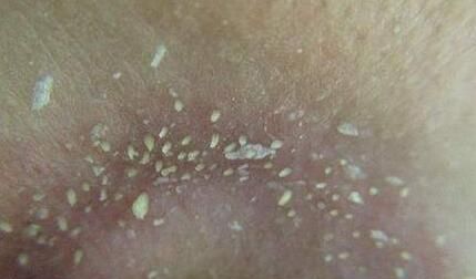 鼻翼两侧长粉刺,鼻子两侧长粉刺要怎么去除?图3