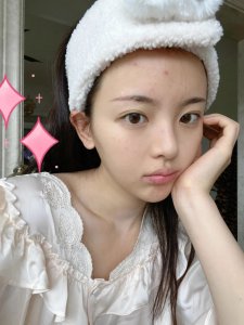 ​如何快速祛痘疤 堪比毁容的千年痘印有救了！这3招你还不知道吗