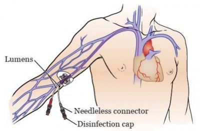 ​什么是picc置管 癌症患者置管如何选择？对比了才知道大有学问