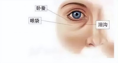 ​泪沟是什么（泪沟到底是软组织的萎缩还是皮肤的松弛）