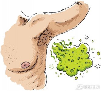 ​腋臭怎么彻底去除？别自卑，医生教你5种方法赶走狐臭