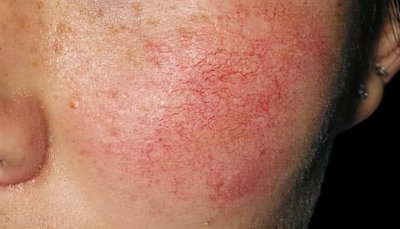 ​脸上红血丝怎么办最有效的方法（脸上的红血丝怎么消除？脸上为什么会有红血丝