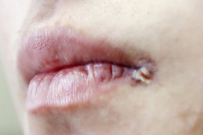 ​口唇疱疹 嘴上长水泡，可能是感染疱疹病毒！如何才能快速消除？能挑破吗？