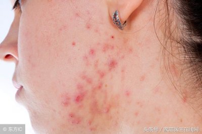 ​痤疮反反复复能自愈吗 痤疮反复发作用什么药