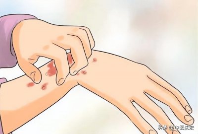 ​抓耳挠腮(荨麻疹反复？痒的抓耳挠腮？中医教你找到适合自己的调理方法)