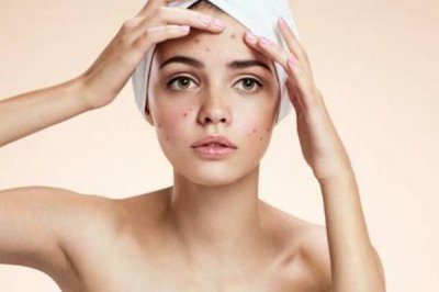 ​痘痘肌肤适合用什么面霜 痘痘肌的形成原因