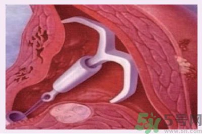 ​什么是宫内节育器？放置宫内节育器为什么能避孕？