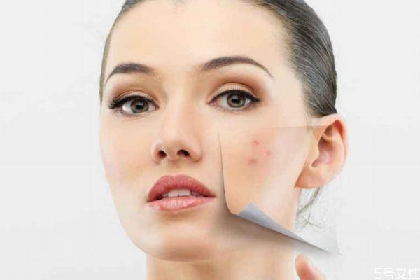 左脸为什么长痘痘呢 左脸长痘痘的原因有什么呢 左脸为什么长痘痘呢 左脸长痘痘的原因有什么呢