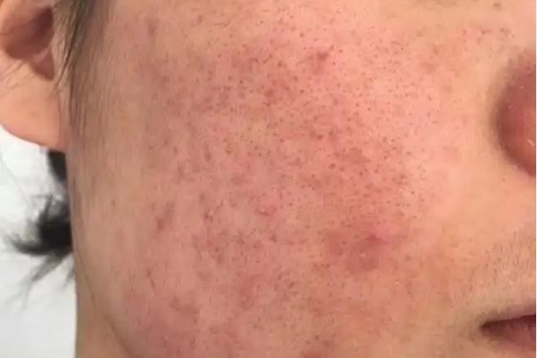 毛孔粗大有痘坑怎么修复 毛孔粗大有几种类型 毛孔粗大有痘坑怎么修复 毛孔粗大有几种类型