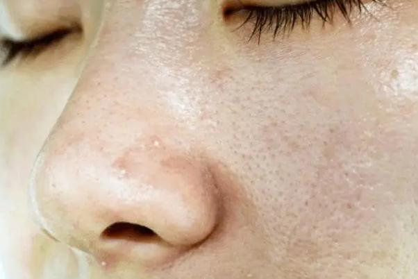 毛孔粗大有痘坑怎么修复 毛孔粗大有几种类型 毛孔粗大有痘坑怎么修复 毛孔粗大有几种类型