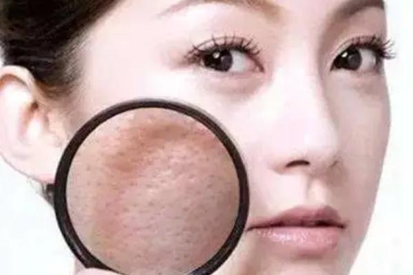 毛孔粗大有痘坑怎么修复 毛孔粗大有几种类型 毛孔粗大有痘坑怎么修复 毛孔粗大有几种类型