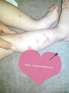 ​宝宝被蚊子咬了怎么办(阴囊被蚊子咬了怎么办)