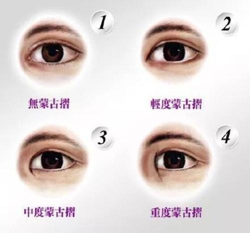 蒙古褶是什么（蒙古褶是啥）